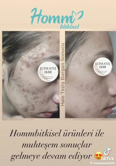 huda beauty tonal krem qiymetleri: Üz serumu, Bütün dəri növləri üçün, Yeni, Ünvandan götürmə, Pulsuz çatdırılma, Ödənişli çatdırılma