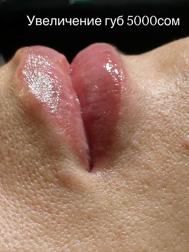 Косметология: Косметология, Увеличение губ, Гипоаллергенные материалы at lalafo.kg — 4 Косметология: Косметология, Увеличение губ, Гипоаллергенные материалы — 4