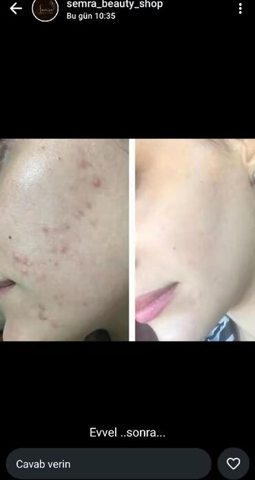 Saçlara qulluq: Saç üçün yağ, Saç tökülməsinə qarşı — 16