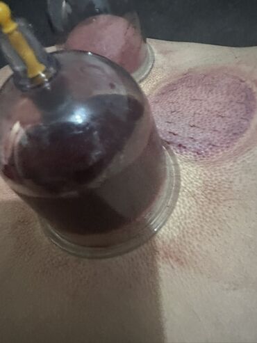 Hicama, zəli: Xidmət: Kupa terapiyası (quru və yaş/hicama), bel–boyun–çiyin masajı — 8