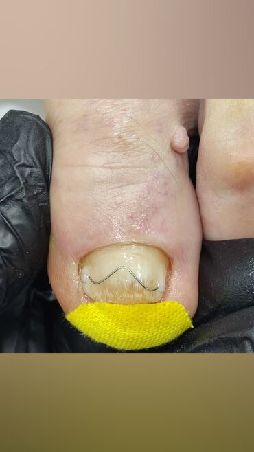 Маникюр, педикюр: Коррекция вросших ногтей, Маникюр, Педикюр, Услуги подолога, Консультация, Одноразовые расходные материалы — 10