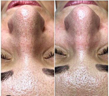 Эпиляция: Город Ош Шугаринг Ош 🔥 Ваксинг Ош 🔥 Всех зон 🔥 Все материалы — 5