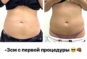 Косметология: Липолитики для проблемных зон. Похудение с первой процедуры. Всё виды — 5
