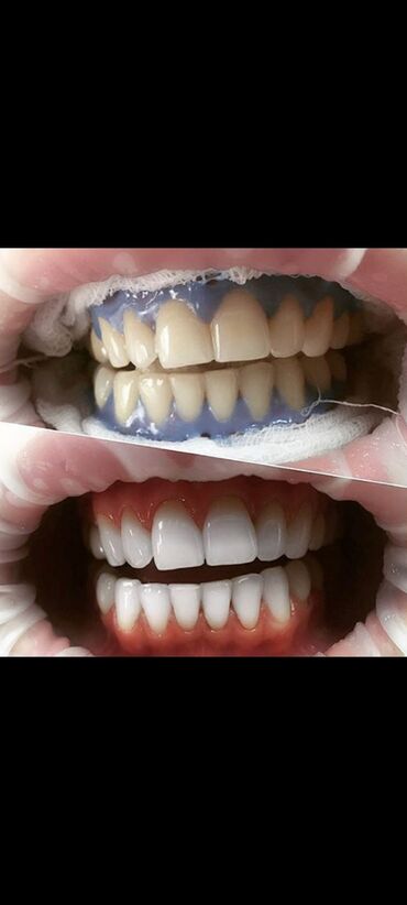 Отбеливание зубов amazing. Отбеливание amazing White флюороз. Амазинг отбеливание зубов. Профессиональное отбеливание зубов amazing White. Лазерное отбеливание amazing White.