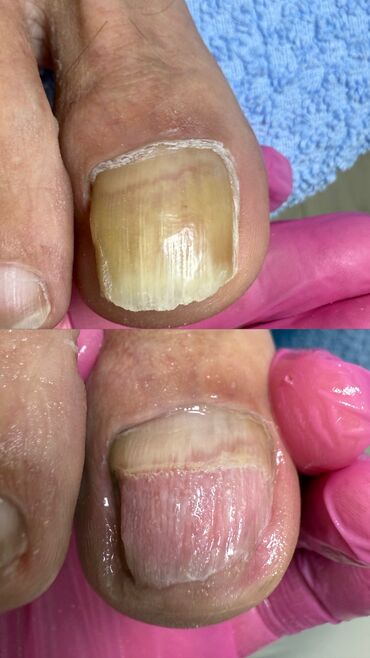 полировачный аппарат: Ичине кирип өскөн тырмактарды оңдоо, Подолог кызматтары, Үйүнө баруу менен, Консультация, Бир жолку сарпталуучу материалдар