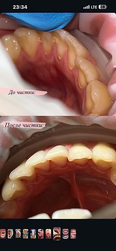 полир: Профессиональная гигиена полости рта - Комплексная чистка: удаление — 2