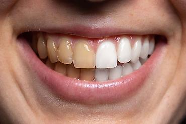 медцентр: 3-х этапная профессиональная чистка зубов - Удаление твердых зубных — 3