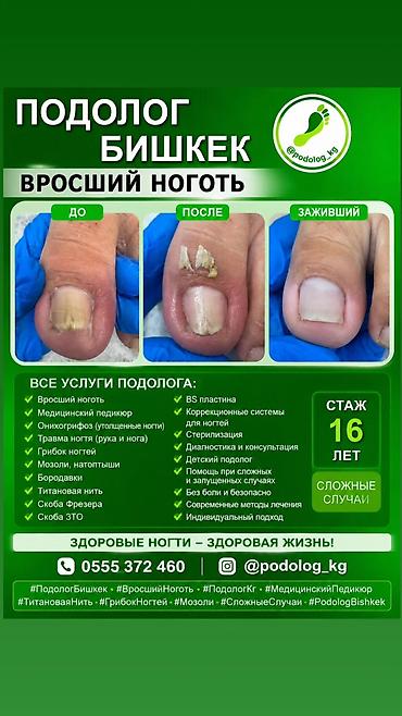 подолог в бишкеке: Коррекция вросших ногтей, Услуги подолога, Консультация — 8