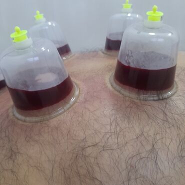 Hicama, zəli: Xidmət: Hicama, hirudoterapiya və masaj - Hicama terapiyası: Bədənin — 5