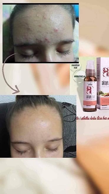 Nega kože: Aknelim gel 30ml – 100% delotvoran saveznik protiv akni Iskoristite — 5