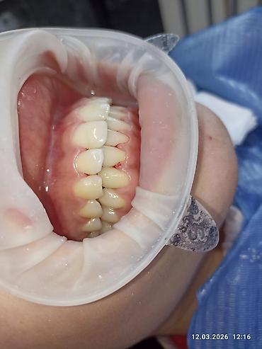 Ортезы: Ортодонтическое лечение: установка брекет‑системы на нижнюю челюсть - — 5