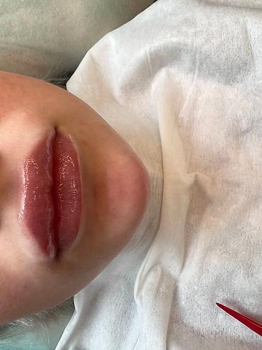 Косметология: Косметология, Ботокс, Биоревитализация, Ботулинотерапия, Консультация, Гипоаллергенные материалы, Сертифицированный косметолог at lalafo.kg — 10 Косметология: Косметология, Ботокс, Биоревитализация, Ботулинотерапия, Консультация, Гипоаллергенные материалы, Сертифицированный косметолог — 10