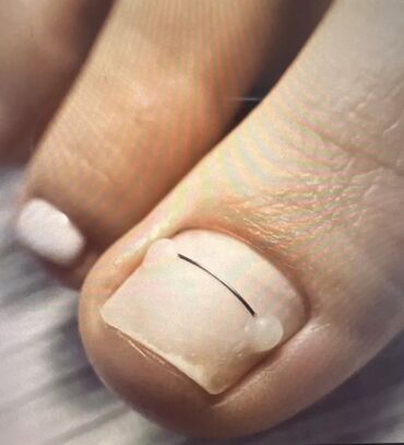 Маникюр, педикюр: Вросший ноготь. Коррекция вросшего сегмента путем удаления врастающих — 5