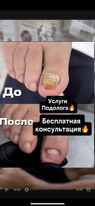 Подолог Бишкек Подолог Бишкек Подолог вросший ноготь Мозоль грибок at lalafo.kg Подолог Бишкек Подолог Бишкек Подолог вросший ноготь Мозоль грибок