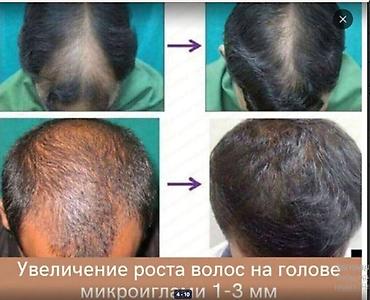 для роста волос: АППАРАТ ОТ ОБЛЫСЕНИЯ И НЕ ТОЛЬКО МНОГО ВИДОВ ВСЕ В ТЕМЕ читаем — 5
