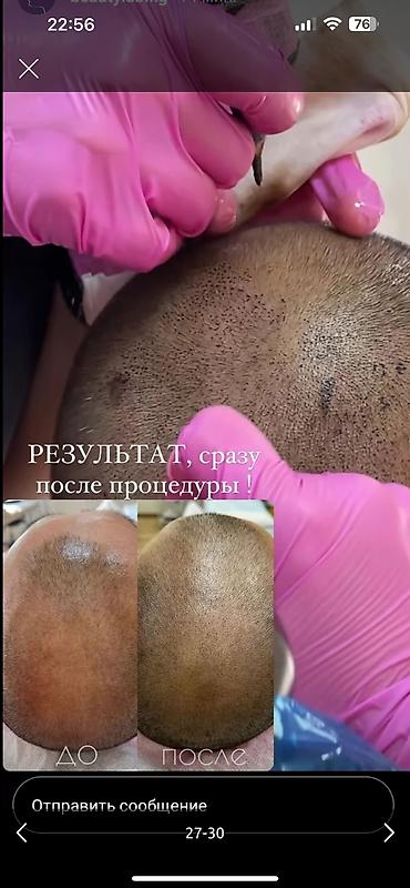 Косметология: Косметология, Ботокс, Биоревитализация, Ботулинотерапия, Консультация, Гипоаллергенные материалы, Сертифицированный косметолог at lalafo.kg — 28 Косметология: Косметология, Ботокс, Биоревитализация, Ботулинотерапия, Консультация, Гипоаллергенные материалы, Сертифицированный косметолог — 28