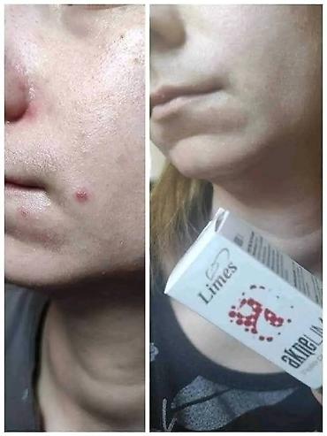 Nega kože: Aknelim gel 30ml – 100% delotvoran saveznik protiv akni Iskoristite — 6