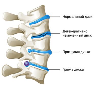 Красота и здоровье: Массаж | Остеохондроз, Межпозвоночная грыжа, Протрузия | Консультация