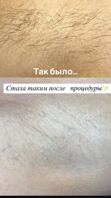 лазерная эпиляция цена: Восковая эпиляция, Мужская эпиляция, Шугаринг, Требуются модели