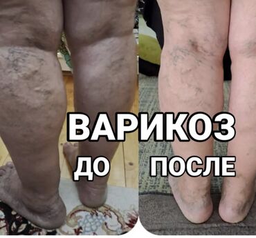 Медицинские услуги: Предлагаю услугу 
Капилляра терапия 
Только для женского Пола