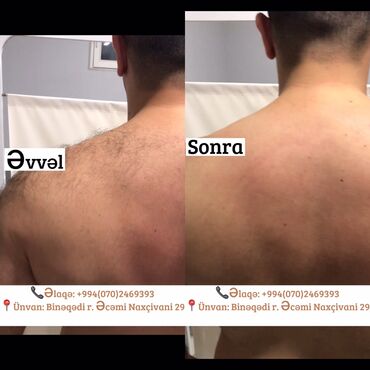 Digər gözəllik və sağlamlıq xidmətləri: Kişilər üçün Lazer Epilasiya✅ Üz,Boyun,Boğaz,Qulaq,Burun = 10 AZN — 3