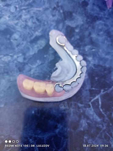 Ортезы: Съемные частичные зубные протезы - Тип: частичные протезы для верхней — 8