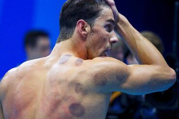 Lepota i zdravlje: Ventuze . CUPPING-fizikalna terapija-akupunktura- čašama Komplet za — 3