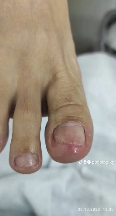 Маникюр, педикюр: Коррекция вросших ногтей, Выравнивание, Услуги подолога, Маникюр, Педикюр, С выездом на дом, Консультация, Одноразовые расходные материалы — 9