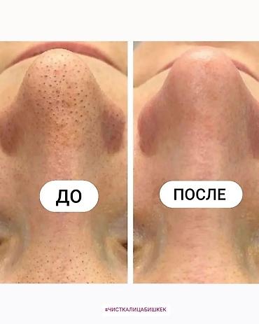 Косметология: Косметология, Чистка кожи, Массаж лица, Лечение угревой болезни, С выездом на дом, Сертифицированный косметолог, Консультация — 5