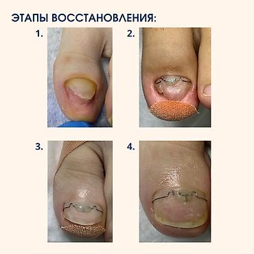 реставрация кривых зубов: Коррекция вросших ногтей, Услуги подолога, Одноразовые расходные материалы — 1
