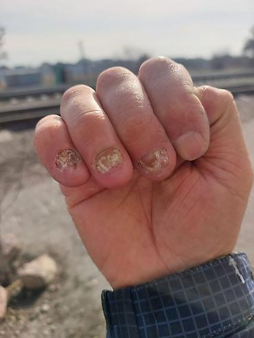 чечим: Подолог Бишкек Подолог, Бишкек, вросший ноготь, трещины на пятках — 8