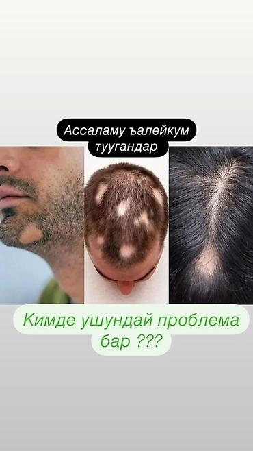 алопеция: Миноксидил Kirkland Signature — средство для стимуляции роста волос — 6