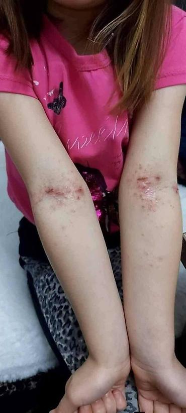 Nega kože: Ide leto,deca su u majicama i sorcicima. Padovi sa — 8