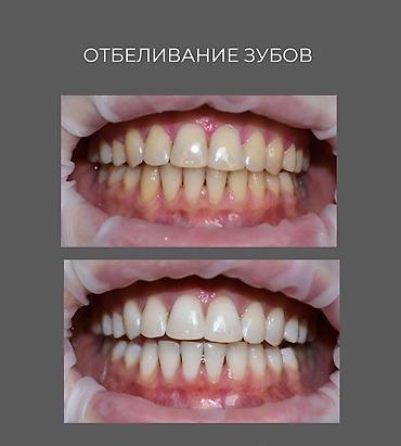 стаматолог: Профессиональное отбеливание зубов - Эффективное осветление эмали на — 1