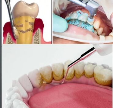 Stomatologiya: Dis daslarin lekelerin temizlenmesi munasib qiymetlerle