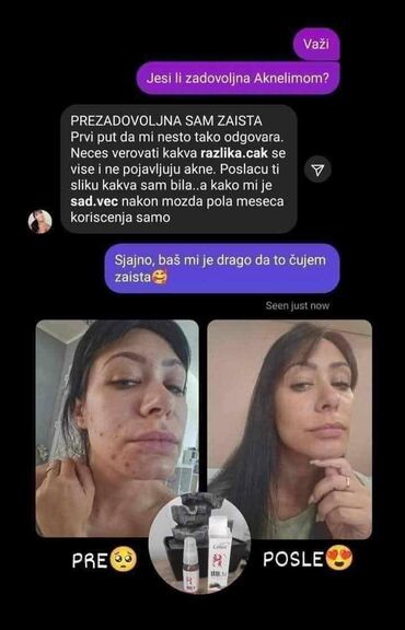 Nega kože: Aknelim gel 30ml – 100% delotvoran saveznik protiv akni Iskoristite — 5