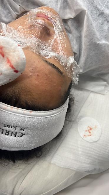 подбородок: Косметология, Чистка кожи, Консультация — 2
