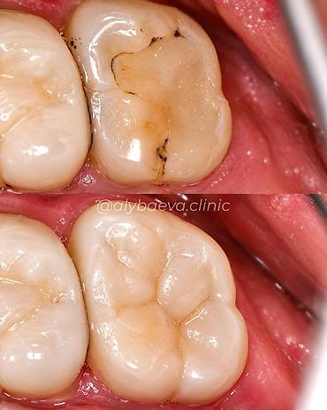 Сулуулук жана ден-соолук: Стоматология Dr. Alybaeva dental clinic Услуги: - Лечение без боли - — 6
