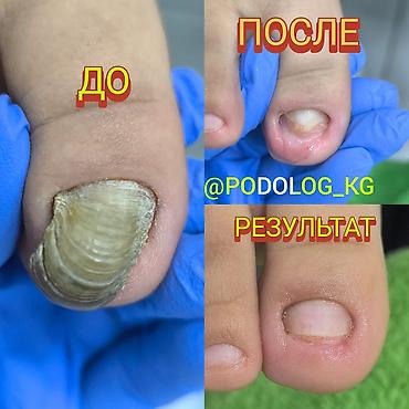 обувь адидас: ПОДОЛОГ БИШКЕК @podolog_kg ДИНАМИКА НОГТЕЙ ДО/ПОСЛЕ/РЕЗУЛЬТАТ Которая — 1