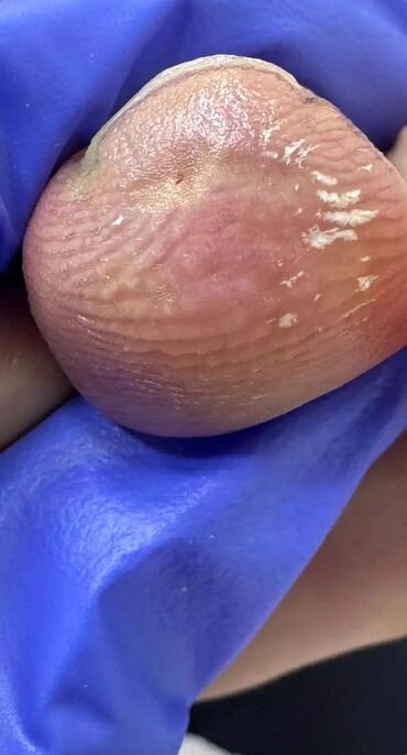 Маникюр, педикюр: Коррекция вросших ногтей, Педикюр, Услуги подолога, Консультация, Одноразовые расходные материалы — 4