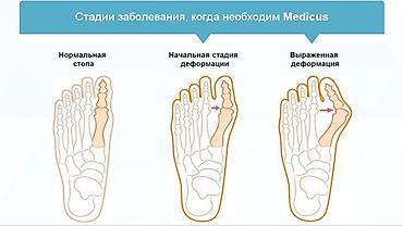 Вальгусные шины: Корректоры для большого пальца ноги от вальгусной деформации(косточки — 3