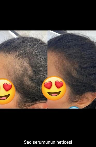 Saçlara qulluq: Saç üçün yağ, Saç tökülməsinə qarşı — 7