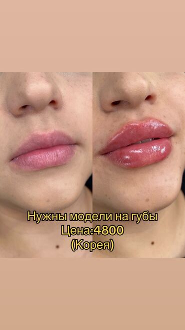 лазерная эпиляция цена бишкек: Увеличение губ по акции