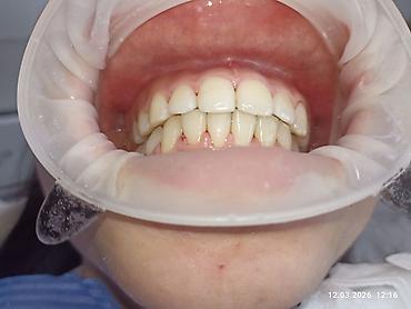 Ортезы: Ортодонтическое лечение: установка брекет‑системы на нижнюю челюсть - — 7