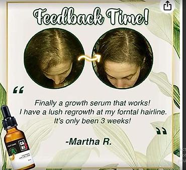 Уход за телом: США средство от облысения от выпадения волос для роста волос будит — 10