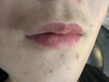 Косметология: Косметология, Маски, Мезотерапия, Удаление носогубных складок, Гипоаллергенные материалы, Консультация, Сертифицированный косметолог — 90