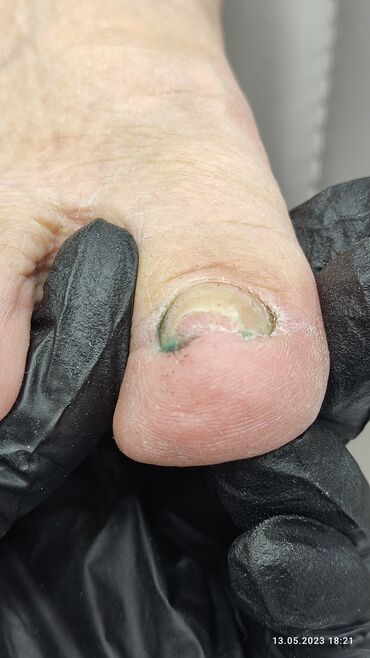 Маникюр, педикюр: Коррекция вросших ногтей, Маникюр, Педикюр, Услуги подолога, Консультация, Одноразовые расходные материалы — 3