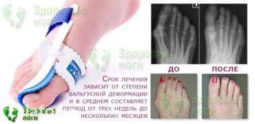 Вальгус шиналары: Бандаж для косточки на ноге купить стоит из-за его поистине — 4