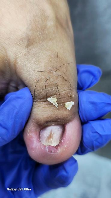 Маникюр: Коррекция вросших ногтей, Услуги подолога, Консультация — 9