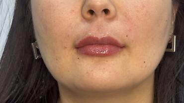 Косметология: Косметология, Увеличение губ, Гипоаллергенные материалы at lalafo.kg — 21 Косметология: Косметология, Увеличение губ, Гипоаллергенные материалы — 21